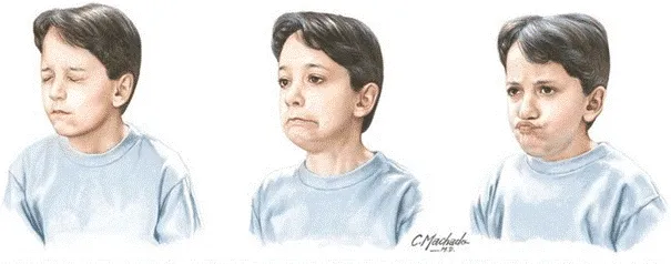 Tourette Sendromu nedir? Tourette Sendromu geçer mi, neden olur, belirtileri ve tedavisi?