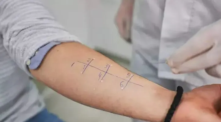 Alerji Testi İçin Hangi Doktora Gidilir? Alerji Testi Hangi Bölüm Bakar?