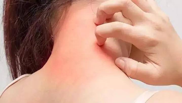 Uyuz Tedavisinde Sirke Kullanımı Nasıl Olur? 