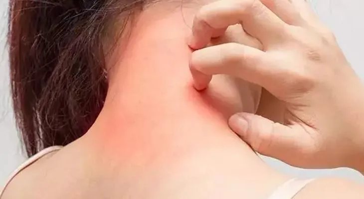 Uyuz Tedavisinde Sirke Kullanımı Nasıl Olur? Evde Uyuz Nasıl Geçer?