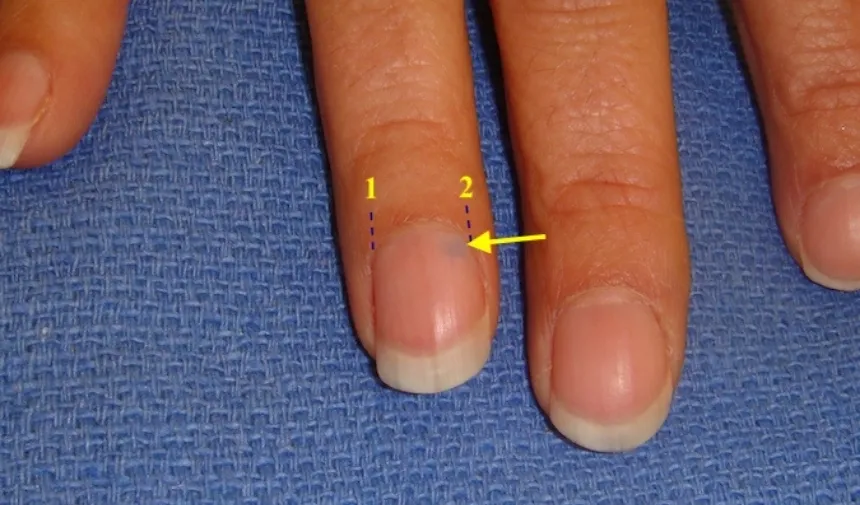 Glomus Tümörü nedir nerede bulunur? Parmakta glomus tümörü belirtileri nelerdir?