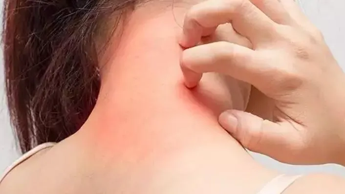 Uyuz Tedavisinde Sirke Kullanımı Nasıl Olur? 