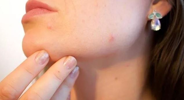 Rüyada Sivilce Sıkmak Ne Anlama Geliyor?