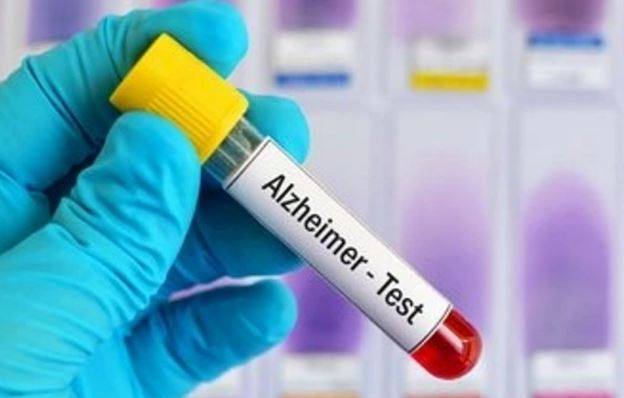Alzheimer teşhisinde umut veren gelişme!