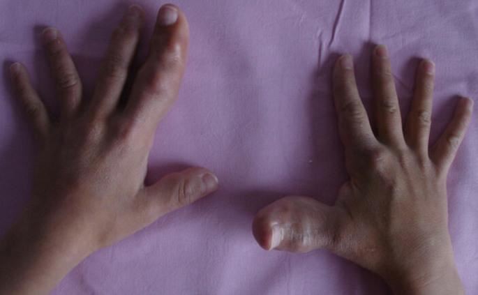 Makrodaktili Hastalığı Nedir? Belirtileri ve Tedavi Yöntemleri ?
