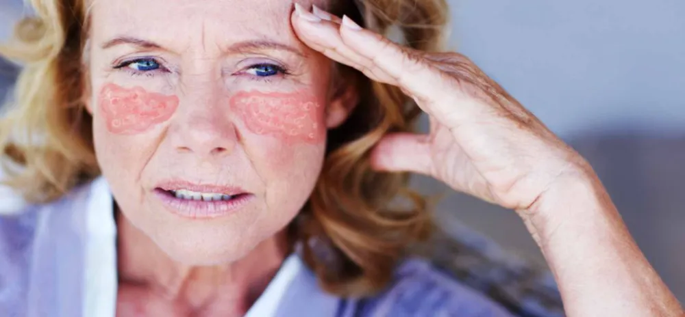 Lupus Hastalığı Nedir?