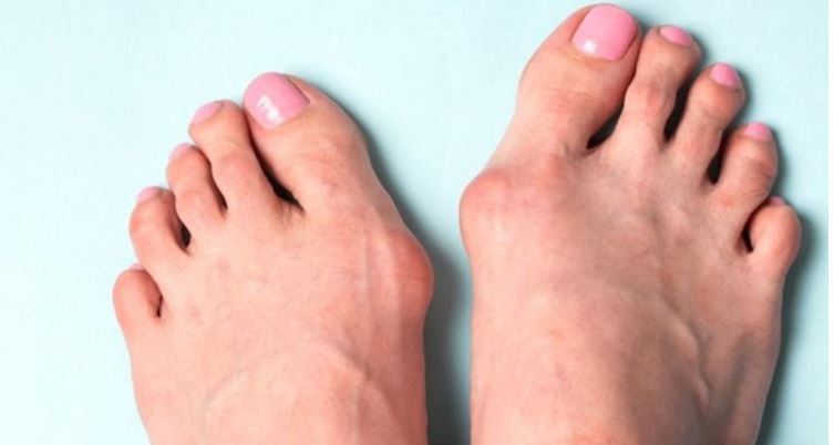 Halluks Valgus Nedir?