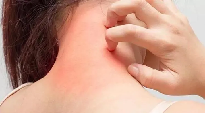 Uyuz Tedavisinde Sirke Kullanımı Nasıl Olur? 