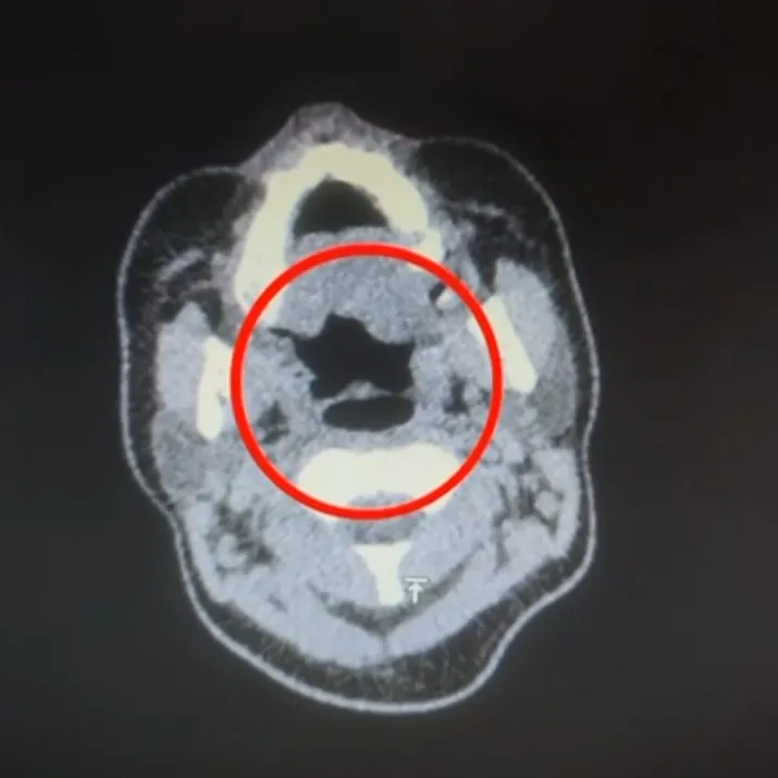 Uluslararası uyuşturucu madde ticareti yapan şüpheli midesinde uyuşturucuyla yakalandı