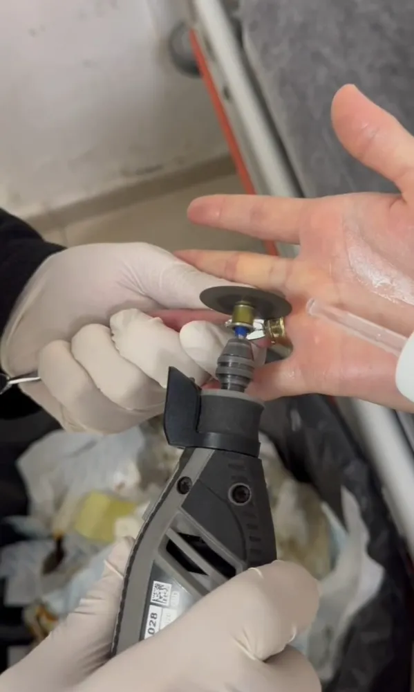 Batman’da Parmağına Sıkışan İki Yüzük, İtfaiyenin Spiral Makinesiyle Çıkartıldı