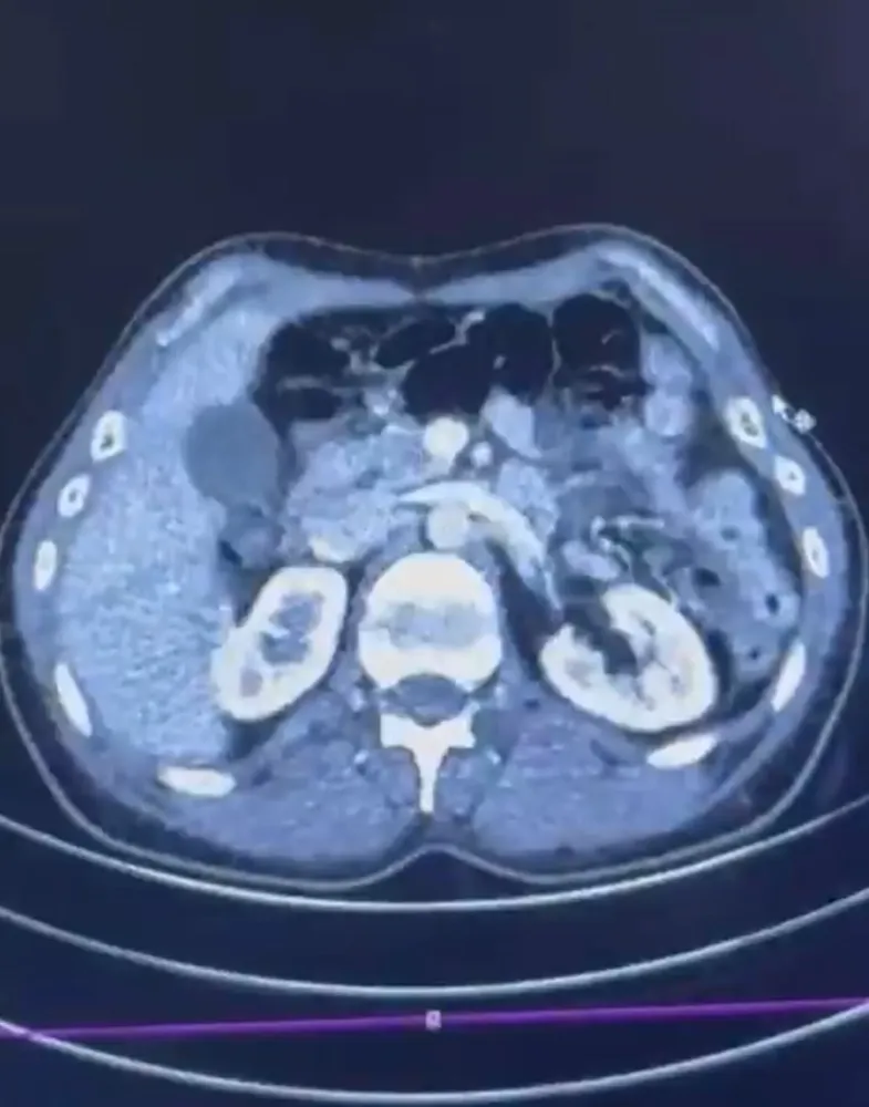 Kayseri’de midesinde uyuşturucu taşıyan şahıslar yakalandı