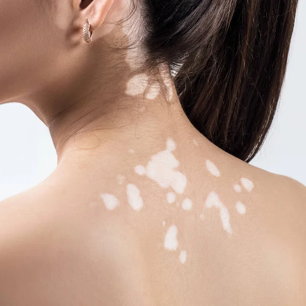 Vitiligo Nedir? Vitiligo Neden Olur? Vitiligo Belirtileri ve Tedavisi Nasıldır?