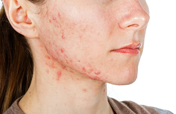 Sivilce İzleri Neden Oluşur? Sivilce Lekeleri Nasıl Giderilir? Sivilce Lekeleri İçin Maske...