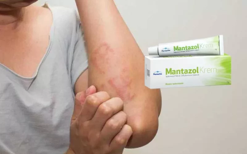 Mantazol Krem Ne İşe Yarar? Mantazol Krem Ne İçin Kullanılır?